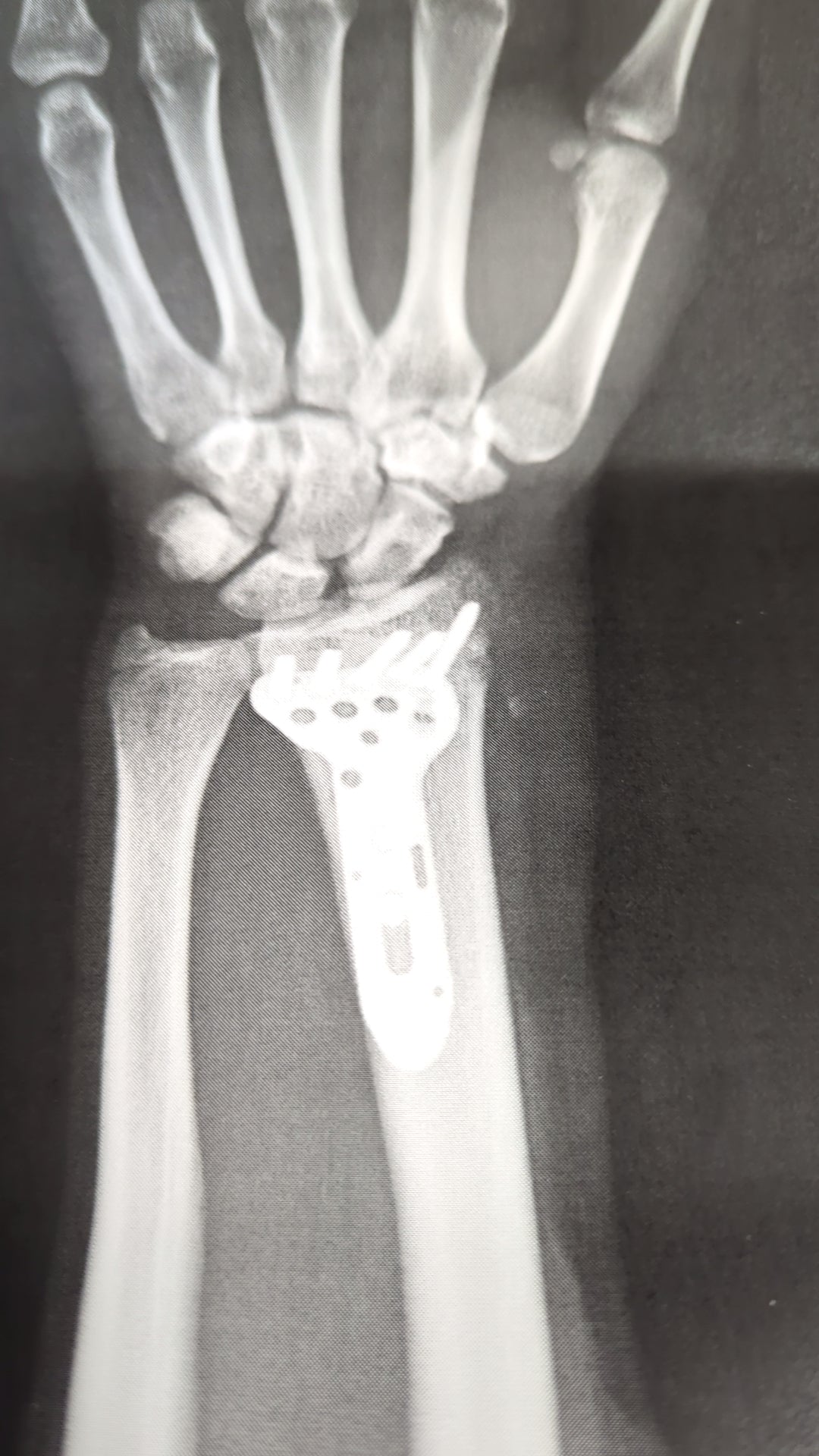 認定ハンド 両手 右手骨折2本有り 認定ハンド 両手 右手骨折2本有り